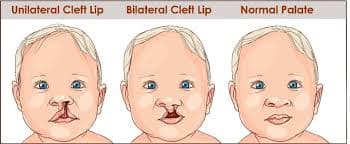 cleft lip palate treatment India